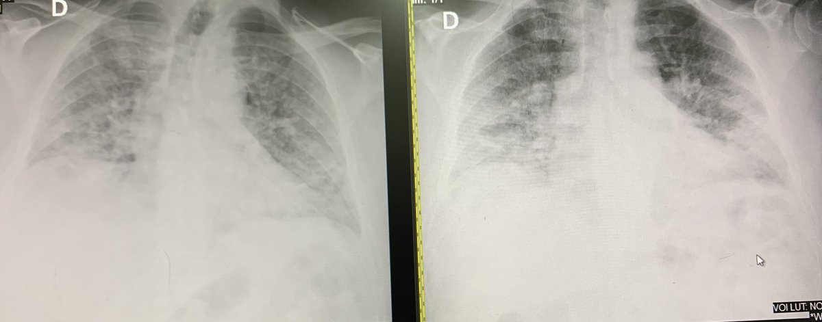 augustoraulhm's tweet photo. Hoy admito masculino de 30 años, proveniente de Chorrera. 

7-8 días de síntomas, tomando Ivermectina, Azitromicina y Vitamina C en casa. 

Saturando 78%, Frecuencia Respiratoria en 42/min. Se intuba. https://t.co/kt7V5a0qc9