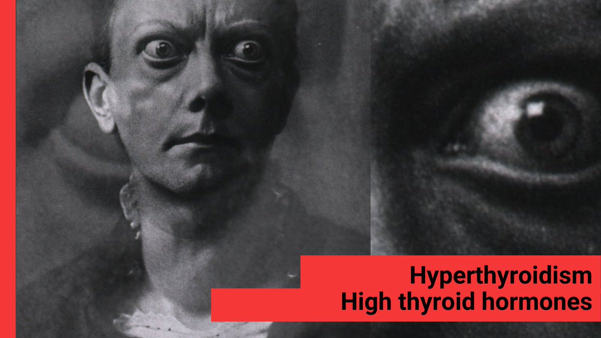 itisthehormones's tweet photo. #HormoneWeekly: Part 2B #Hyperthyroidism & Graves' Disease
Are you losing weight? Have a fast heart beat & tremors?
These are some of the symptoms of HIGH thyroid hormones. A THREAD
(Review of thyroid hormones check https://t.co/wI5t2EAK6S) #ThyroidAwarenessMonth #EndoTwitter https://t.co/Y3kquqpsle