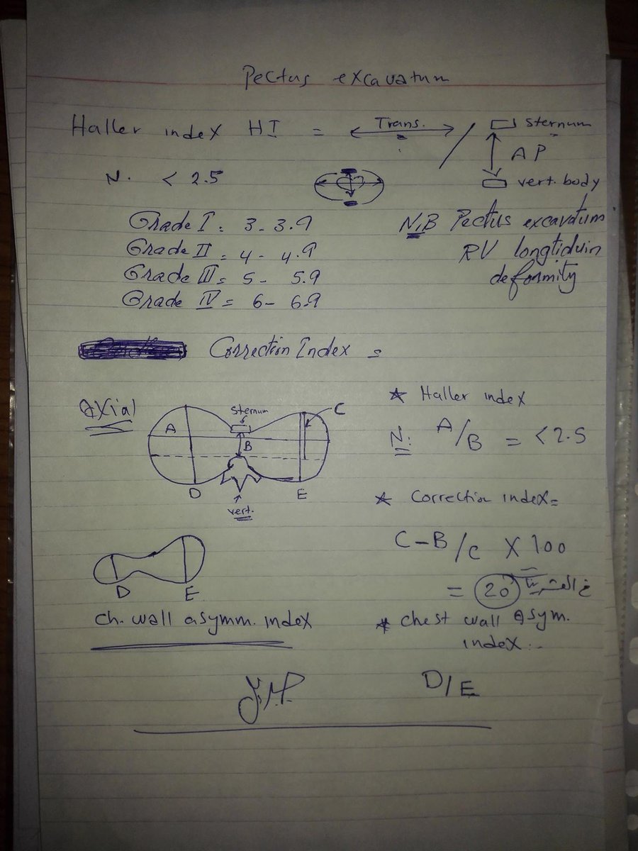 MGibreel1's tweet image. Pectus excavatum (Grade1), with longitudinal deformation of the RV &amp;amp; chest asymmetry,,, important measurements