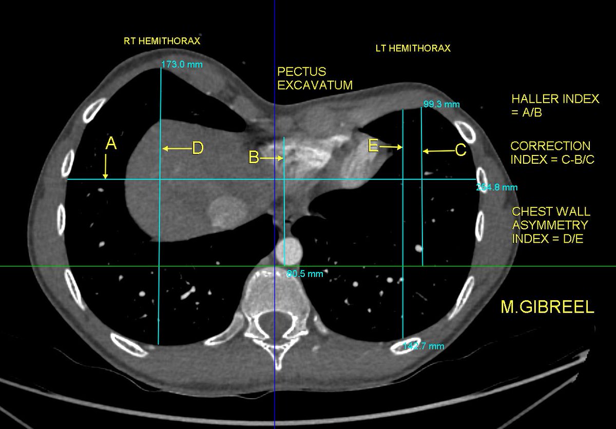 MGibreel1's tweet image. Pectus excavatum (Grade1), with longitudinal deformation of the RV &amp;amp; chest asymmetry,,, important measurements