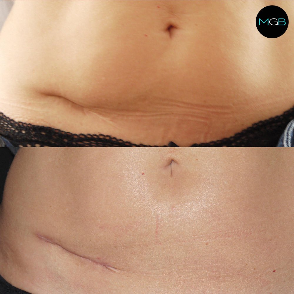 MrMilesBerry's tweet photo. A simple case of scar revision - Please call 020 7486 6778 for enquiries 

https://t.co/TVxOJIzHnv

Even at the extremely early 6 week stage, this patient now feels able to consider a bikini for the first time in years 😊

#scarrevision #scarcamouflage #scarremoval https://t.co/l4ghYHKRgt