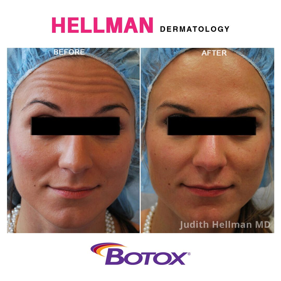 Dr. Judith Hellman uses Botox to relax forehead wrinkles, enhancing your appearance.

#botox #wrinkletreatment #beforeandafter #cosmetictreatments #dermatologistnyc #nycderm #nycdermatologist #drjudithhellman #cosmeticdermatologist #bigappleskin #hellmandermatology #smoothskin