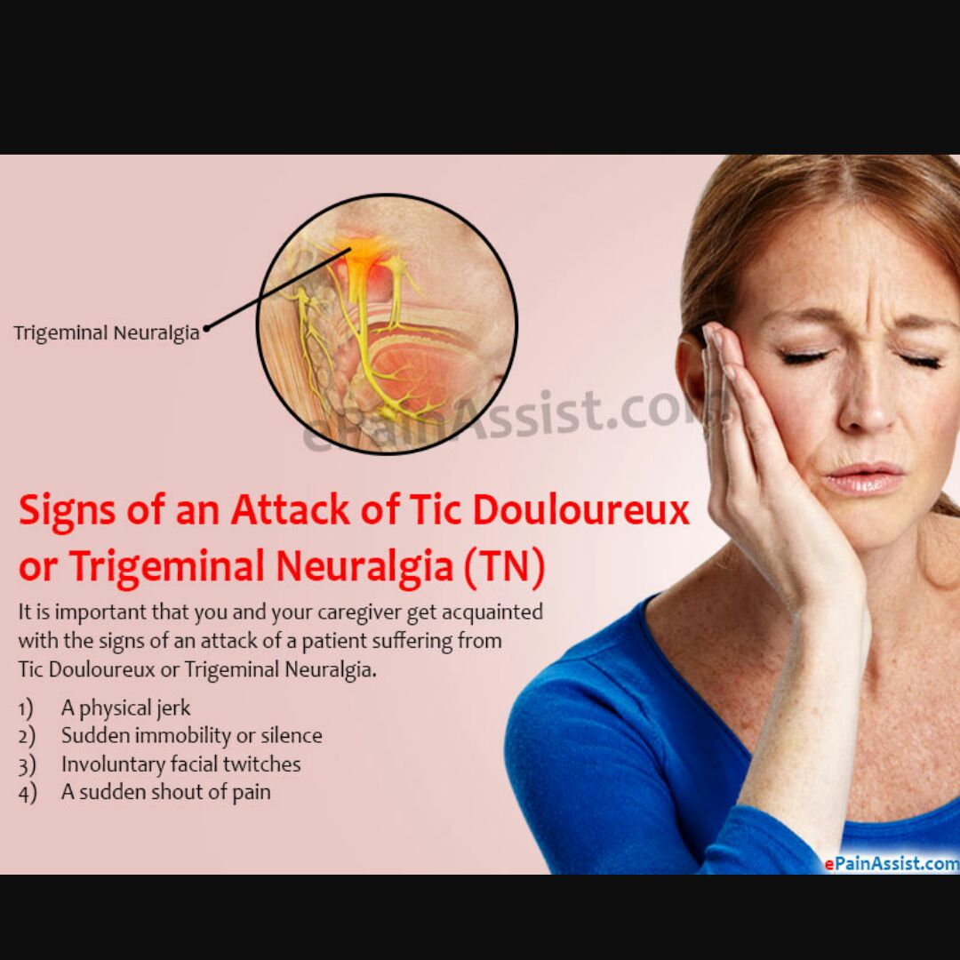 IhabFathiSulima's tweet image. #Trigeminal #neuralgia .