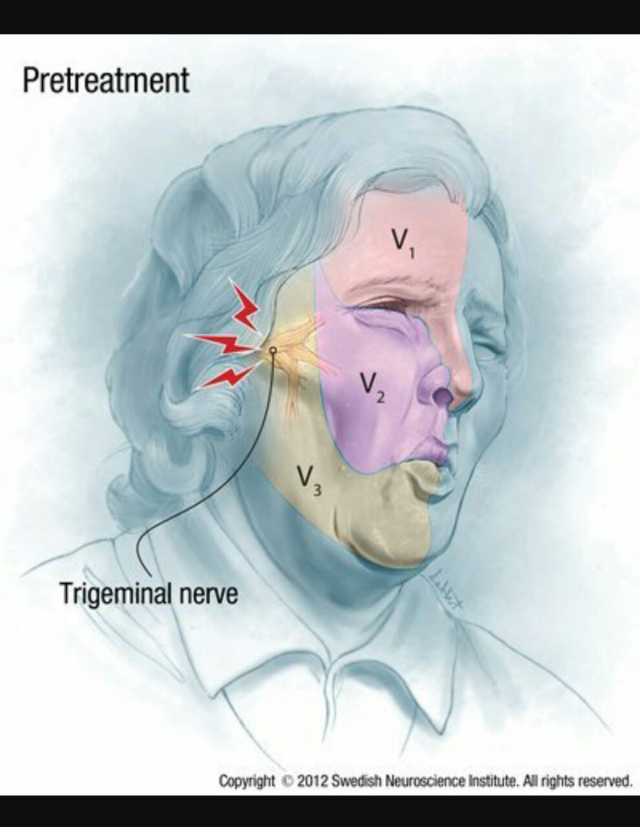 IhabFathiSulima's tweet image. #Trigeminal #neuralgia .