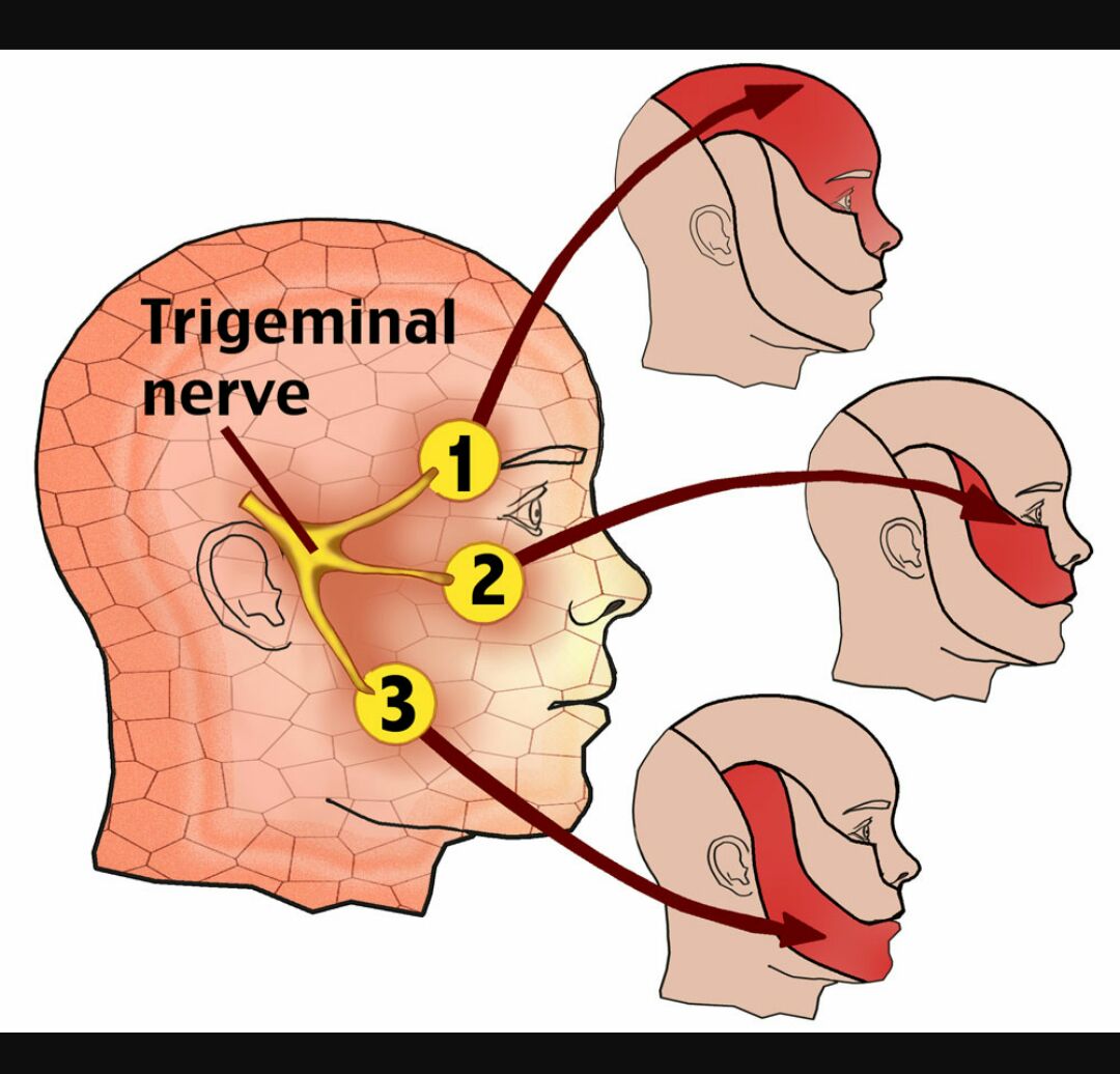 IhabFathiSulima's tweet image. #Trigeminal #neuralgia .