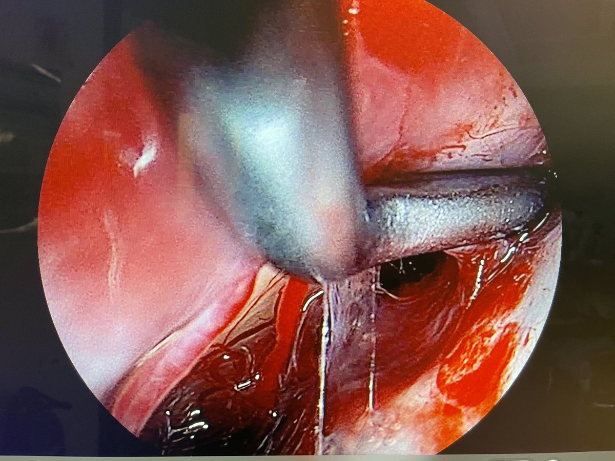 amirdehdashti's tweet photo. Sup hypophyseal arteries are under estimated in both endovascular and open neurovascular surgery. Here’s a beautiful view of these important vessels supplying the chiasm preserved after clipping of an SHA #aneurysm. Only visualized with #QEVO assist @cvsection @NeurosurgeryCNS https://t.co/guNIsdfSxx