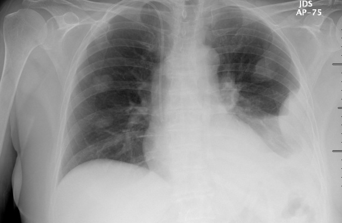 Hi all - quick procedural  #IMPOCUS case for y'all today. We have a 75 yo M w metastatic lung CA, consulted for therapeutic thoracentesis. Initial CXR here 1/