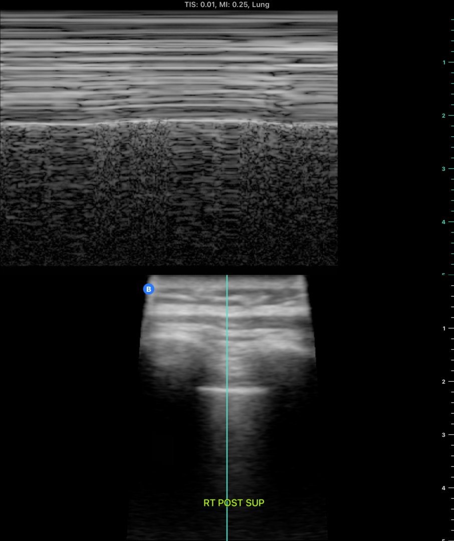 6/ Left post sup view in M-mode. Nice sandy beach.