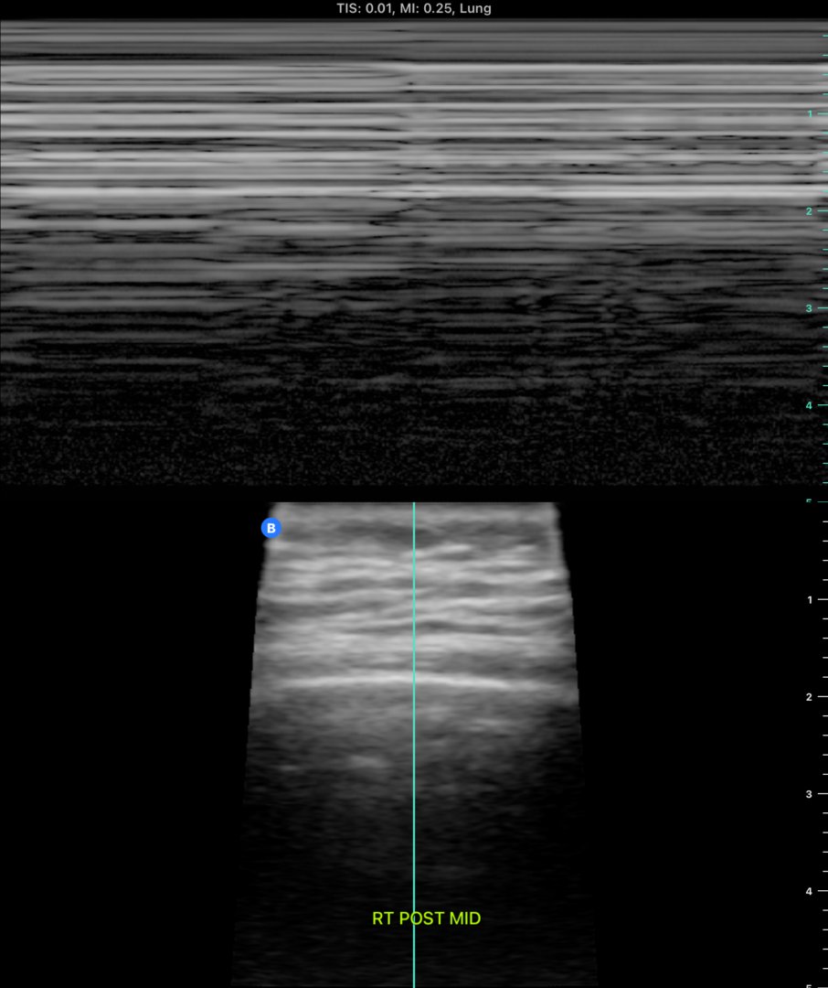 7/ Left posterior mid looked concerning and M-mode revealed: