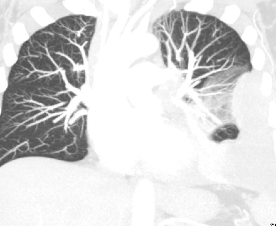 13/ While waiting impatiently for CXR, let's look back at a prior CT. Notice the large mass in the middle of the left lung.