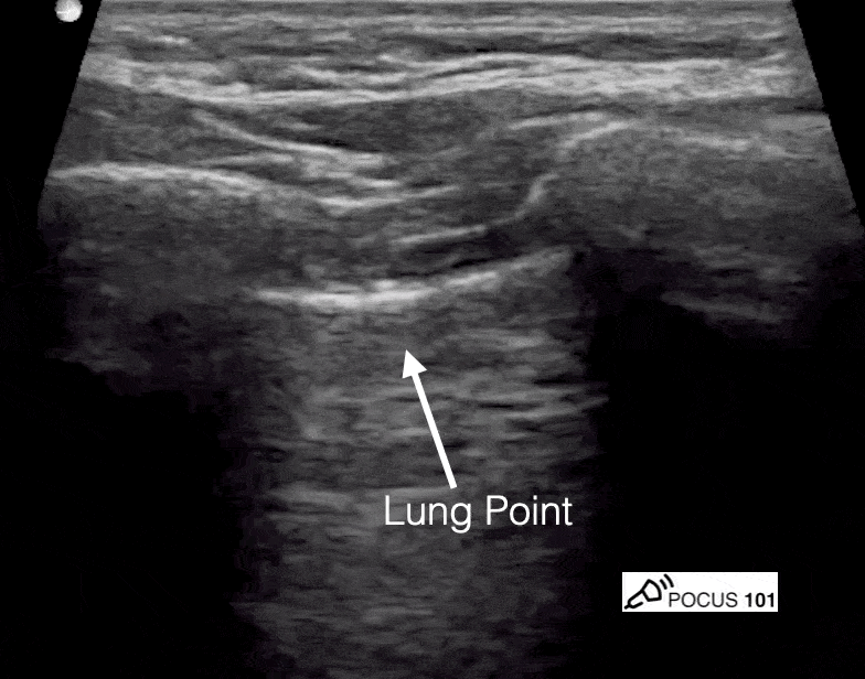 16/ Lung point, however, is far more specific for PTX but this was not found in this case. (thanks  @pocus101)