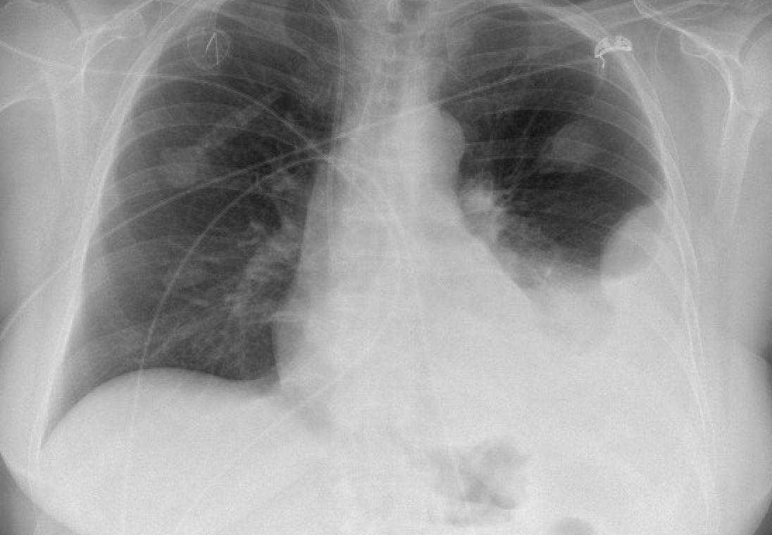 14/ Post-procedure CXR returns and is read to have no PTX.