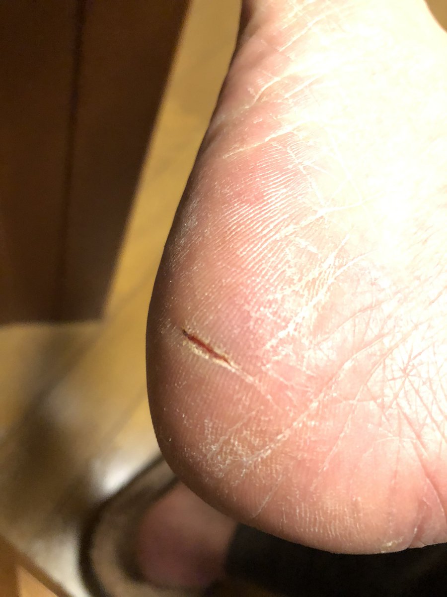 テル 手足のアカギレに酷く悩んでいます 踵がパックリ割れて走れない ということでランoffです また一つ言い訳ができてしまった ランニング好き あかぎれ 朝ラン T Co Rm7e6dufzv Twitter