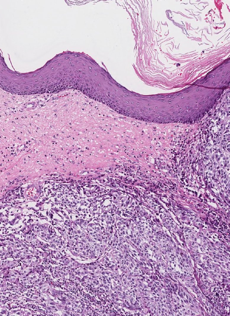 PatMcIntireMD's tweet photo. Breast: Melanoma

Immunostain - BRAFV600E https://t.co/GQqlpDXS6V