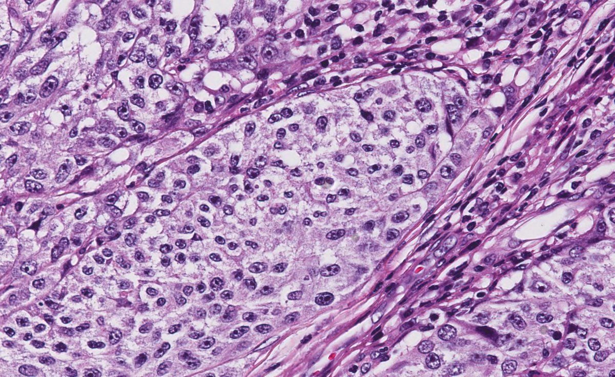 PatMcIntireMD's tweet photo. Breast: Melanoma

Immunostain - BRAFV600E https://t.co/GQqlpDXS6V