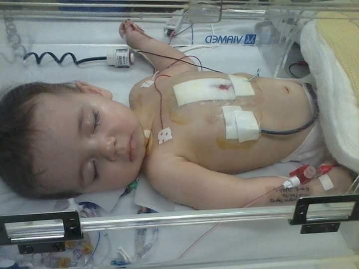 samsy's tweet photo. 6 yrs to the day since my little one had open ❤️ surgery at @AlderHey . The photo may not be pleasant to look at, but it's thanks to this wonderful place that she's here today (had an ASD &amp; large VSD). If you give to charity, pls consider @AlderHeyCharity - literally life savers! https://t.co/rGZmopMADr