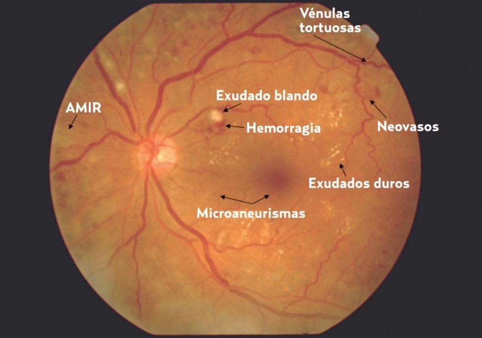 MedAPrez's tweet photo. Detección, diagnóstico y tratamiento de la Retinopatia diabética. Revisión GPC. #ENARM #ENARM2021 https://t.co/fvgIhGnutO