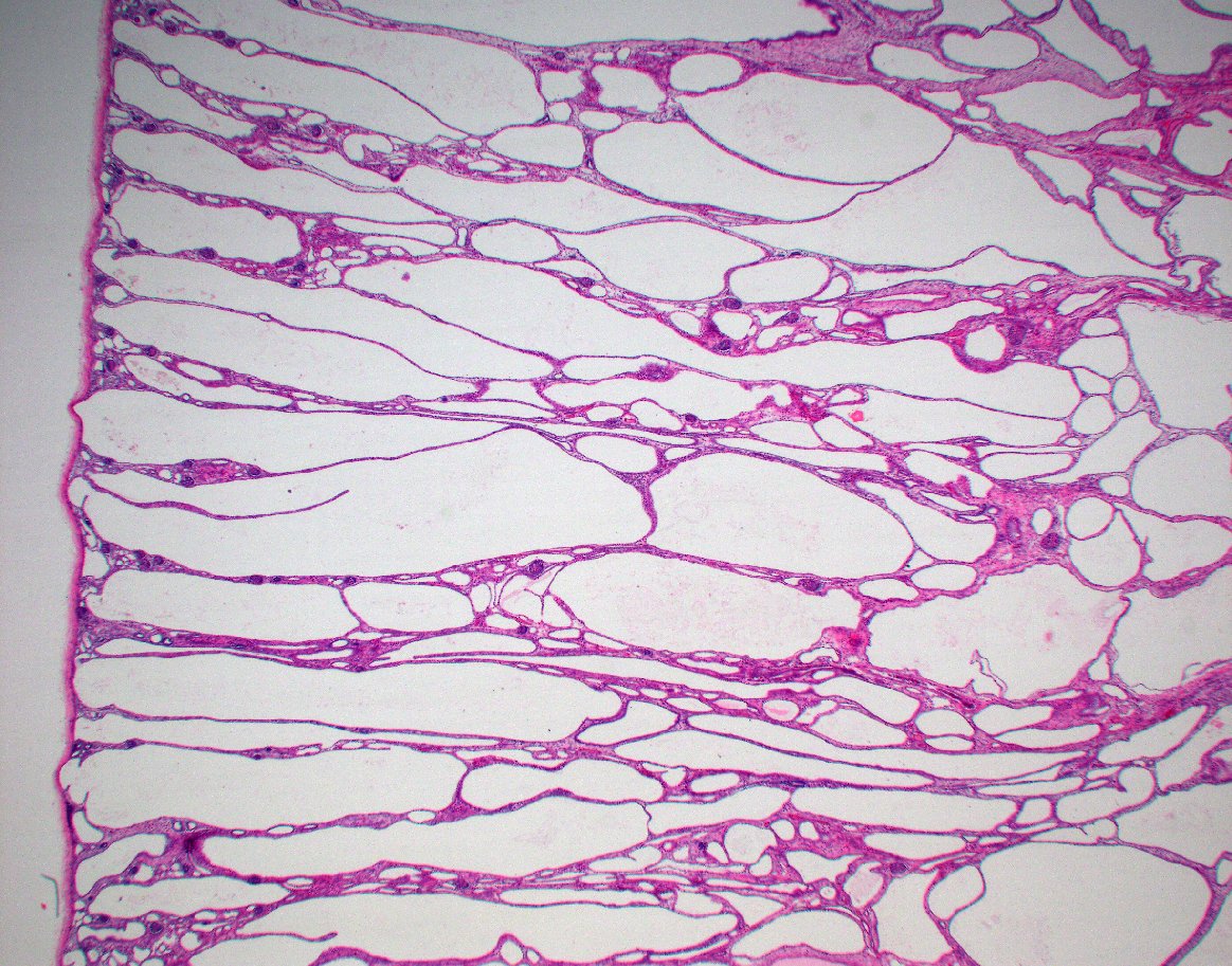 JZRenalPath's tweet photo. Classic example of autosomal recessive polycystic kidney disease.  Large kidneys with poor corticomedullary differentiation radially arrayed cysts. Fusiform dilatation of radially oriented cortical and medullary collecting duct.  #renalpath #gupath https://t.co/7XcKpyyKTx
