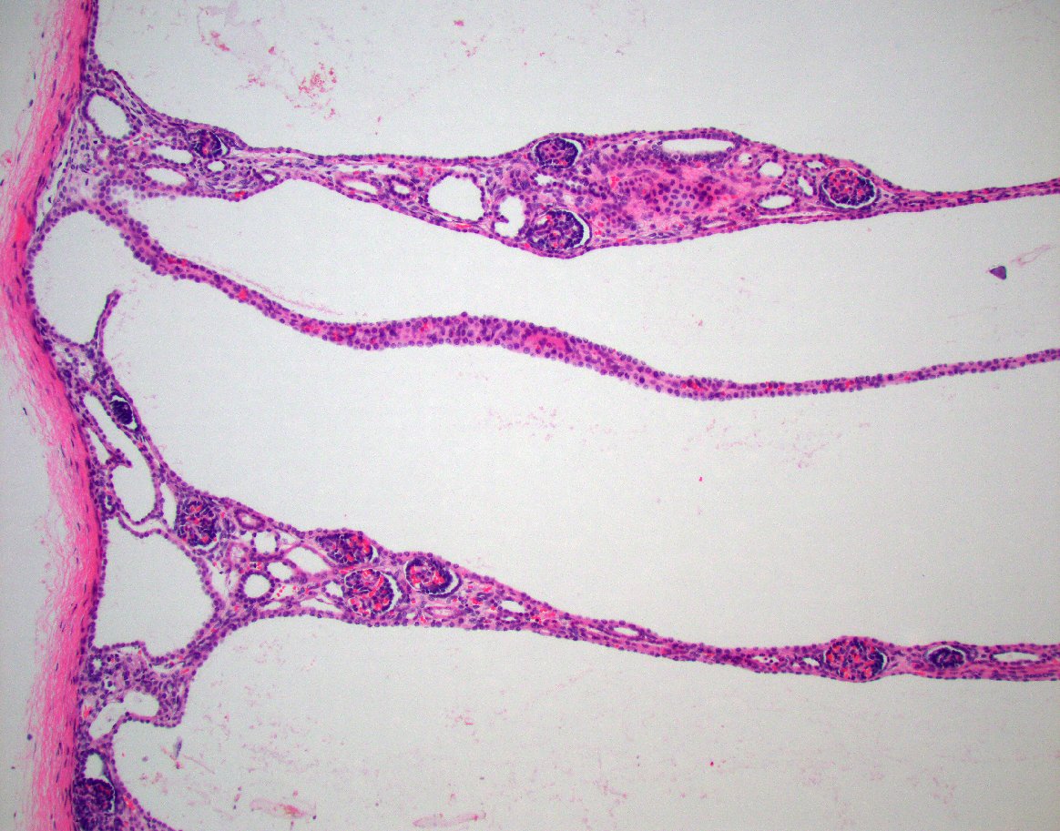 JZRenalPath's tweet photo. Classic example of autosomal recessive polycystic kidney disease.  Large kidneys with poor corticomedullary differentiation radially arrayed cysts. Fusiform dilatation of radially oriented cortical and medullary collecting duct.  #renalpath #gupath https://t.co/7XcKpyyKTx