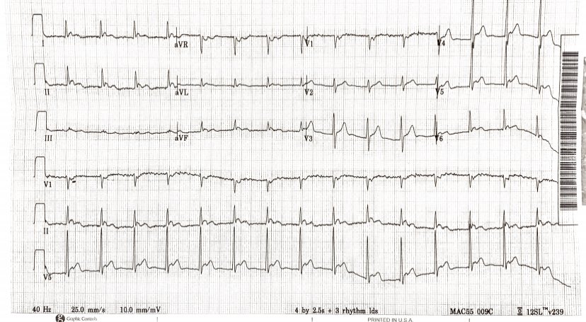 55 yo male with mild fatigue. Diagnosis? #EPeeps #epfellows #Cardiologyfellows #EKG #ECG @VZeitjian