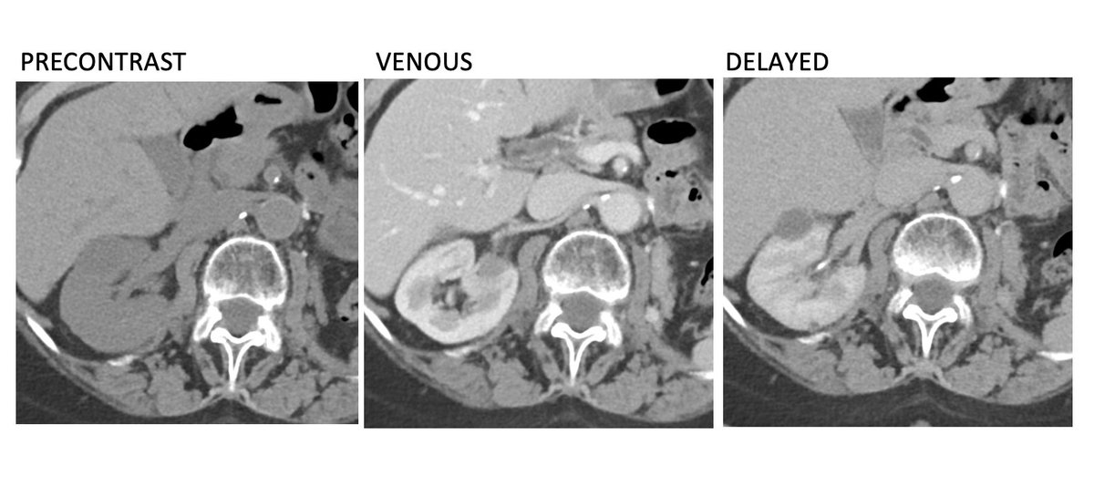 Body CT Pearls& Pitfalls: Take 8History of left kidney clear cell renal cell carcinoma status post nephrectomy. What is your recommendation based on this surveillance CT scan?  @allaf_mo  @m_e_nielsen  @HopkinsNucs  @Hopkins_Rad  @theAPDR  @ACRRFS  @ctisus
