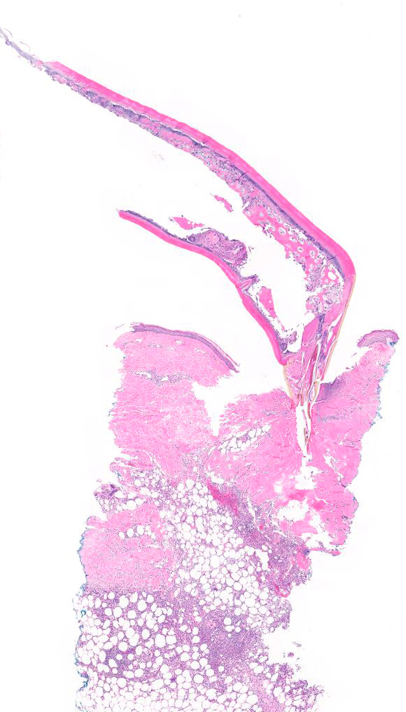 JCloutierMD's tweet photo. NOT your typical arthropod bite reaction. Caught this guy mid-meal. 😱 #dermpath https://t.co/dizKxCbgOg