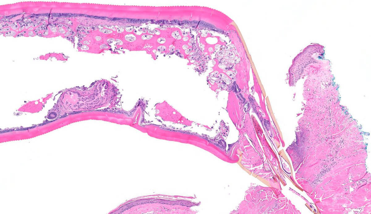 JCloutierMD's tweet photo. NOT your typical arthropod bite reaction. Caught this guy mid-meal. 😱 #dermpath https://t.co/dizKxCbgOg