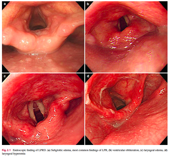 RodriguezParra_'s tweet photo. 🔸Laryngopharyngeal area can be easily ignored by endoscopists.

🔸Laryngopharyngeal lesions:
🔹Reflux laryngopharyngitis
🔹Corrosive lesion
🔹Benign tumors: Papilloma, lipoma, cyst, and vocal cord nodule; 
🔹Malignant tumors and laryngeal cancer.

📘Current GI Endoscopy 2014. https://t.co/iMLeAxtfAw
