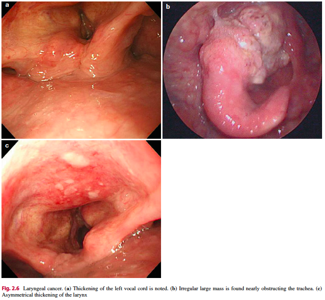 RodriguezParra_'s tweet photo. 🔸Laryngopharyngeal area can be easily ignored by endoscopists.

🔸Laryngopharyngeal lesions:
🔹Reflux laryngopharyngitis
🔹Corrosive lesion
🔹Benign tumors: Papilloma, lipoma, cyst, and vocal cord nodule; 
🔹Malignant tumors and laryngeal cancer.

📘Current GI Endoscopy 2014. https://t.co/iMLeAxtfAw