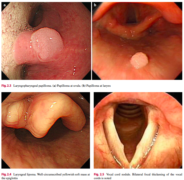 RodriguezParra_'s tweet photo. 🔸Laryngopharyngeal area can be easily ignored by endoscopists.

🔸Laryngopharyngeal lesions:
🔹Reflux laryngopharyngitis
🔹Corrosive lesion
🔹Benign tumors: Papilloma, lipoma, cyst, and vocal cord nodule; 
🔹Malignant tumors and laryngeal cancer.

📘Current GI Endoscopy 2014. https://t.co/iMLeAxtfAw