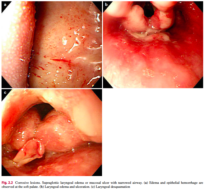 RodriguezParra_'s tweet photo. 🔸Laryngopharyngeal area can be easily ignored by endoscopists.

🔸Laryngopharyngeal lesions:
🔹Reflux laryngopharyngitis
🔹Corrosive lesion
🔹Benign tumors: Papilloma, lipoma, cyst, and vocal cord nodule; 
🔹Malignant tumors and laryngeal cancer.

📘Current GI Endoscopy 2014. https://t.co/iMLeAxtfAw