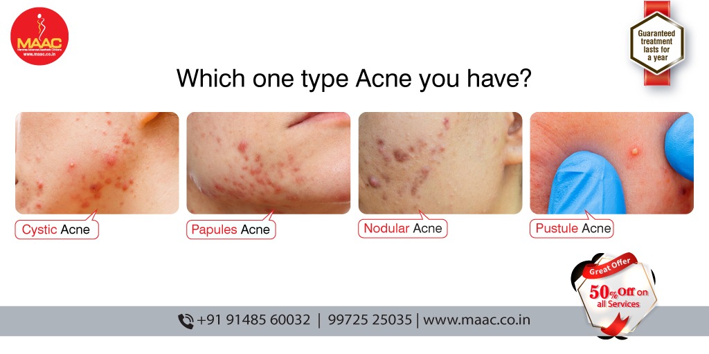 For those who have #acne, please let us know through comment.
Make assured you get treated immediately.
#MAAC experts know the right solutions.
Presenting world-class SKIN INFUSION Solution for all your #skinproblems.

#skininfusion #skintreatement #skincare #antiaging