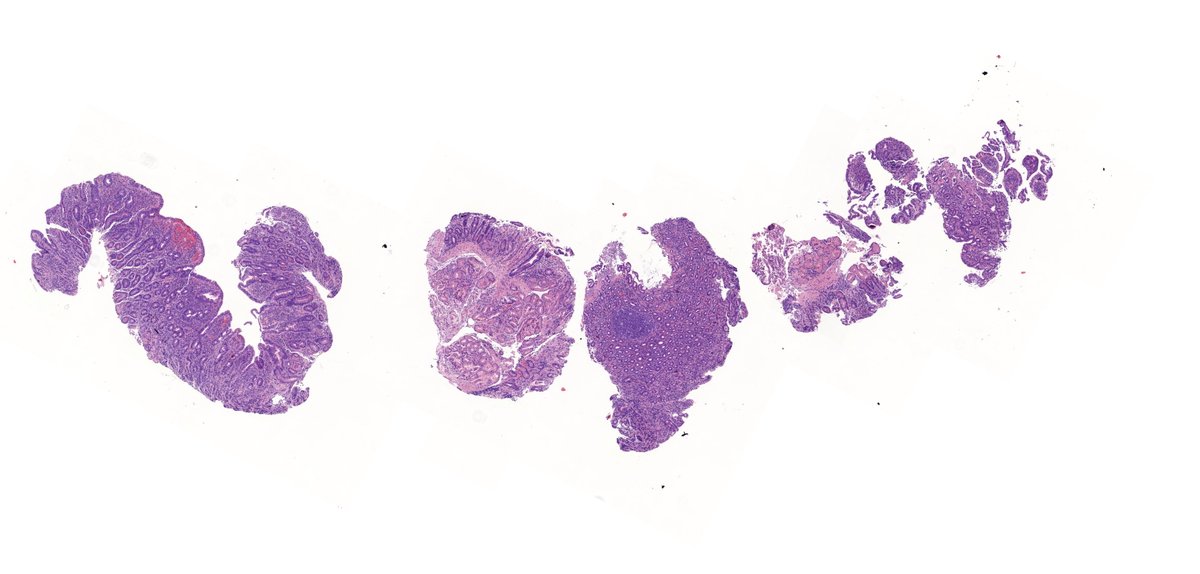 TristanRutland7's tweet photo. ⚕️Small bowel, 70-year-old male, 
 
➡️Presents with ~3 months of chronic non-bloody diarrhoea and weight loss.
 
✏️Request form:
      Diarrhoea

#GIpath #Pathtwitter #Medtwitter https://t.co/rpftvcfTXE