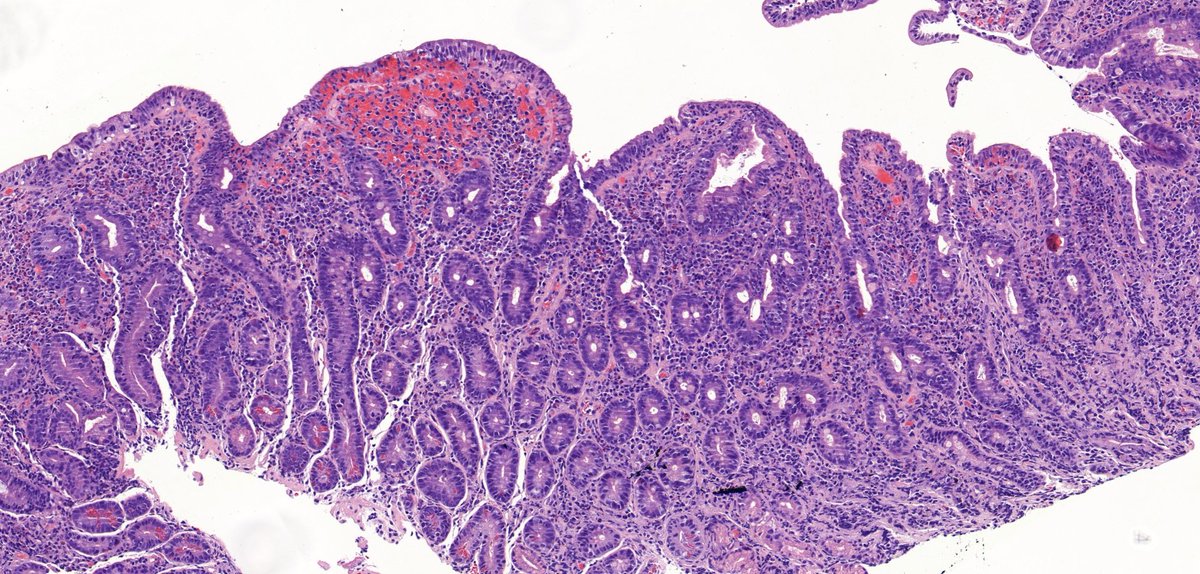 TristanRutland7's tweet photo. ⚕️Small bowel, 70-year-old male, 
 
➡️Presents with ~3 months of chronic non-bloody diarrhoea and weight loss.
 
✏️Request form:
      Diarrhoea

#GIpath #Pathtwitter #Medtwitter https://t.co/rpftvcfTXE