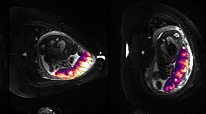 What happens when women in late pregnancy lie on their back rather than their side? We found a 6.2% decline in oxygen transfer across the placenta; blood flow to the uterus fell by 23.7%. Women should #SleepOnSide in late pregnancy to prevent #Stillbirth <a href="/SandsUK/">Sands - baby loss charity 💜🧡</a> <a href="/tommys/">Tommy's</a> <a href="/ucl/">UCL</a>
