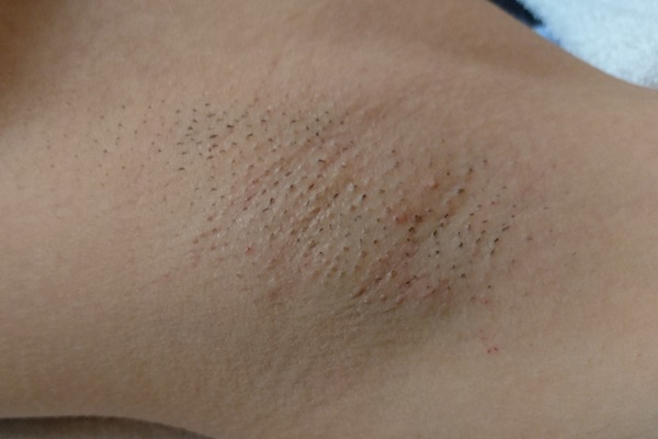 تويتر 脇の黒ずみ البحث في تويتر