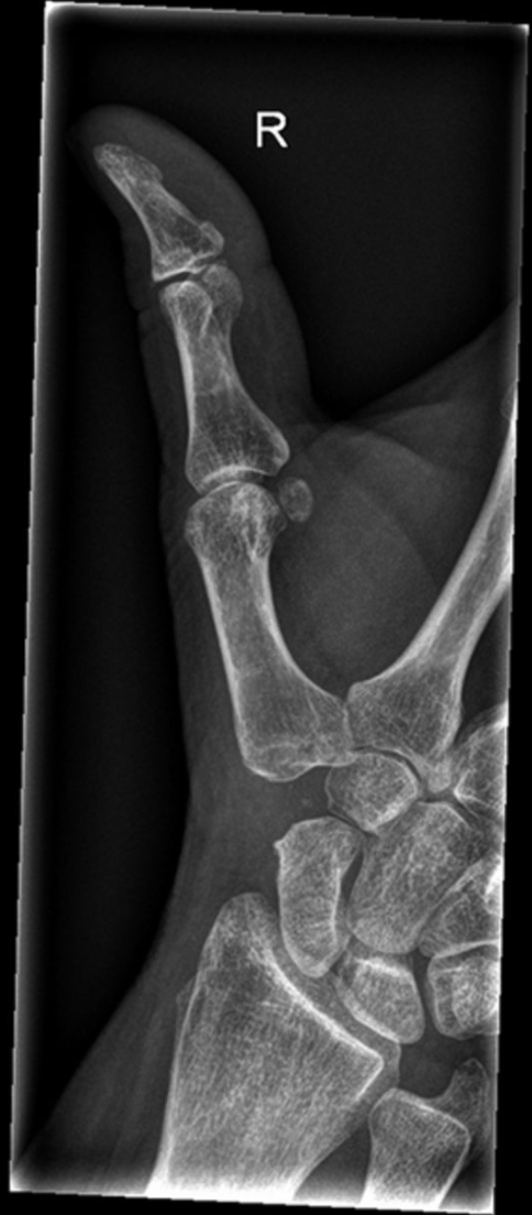 Trapeziometacarpal Arthrodesis or Trapeziectomy with Ligament Reconstruction in Primary Trapeziometacarpal Osteoarthritis -- A Randomized Controlled Trial

ow.ly/B54V50D5sdp