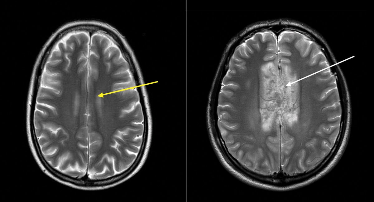 Why are women more likely to be adversely affected by a traumatic head injury (TBI/mild TBI) than men?Because every body has a sex.