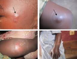 Early presentation at a hospital will go a long way in preventing serious disabilities/morbidity.The first sign of Buruli ulcer is a painless swollen bump on the arm or leg, often similar in appearance to an insect bite. Sometimes the swollen area instead appears as a patch...