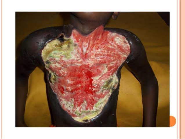 Large ulcers may extend deep into underlying tissue, causing bone infection and exposing muscle, tendon, and bone to the air. When ulcers extend into muscles and tendons, parts of these tissues can be replaced by scar tissue, immobilizing the body part and resulting in...