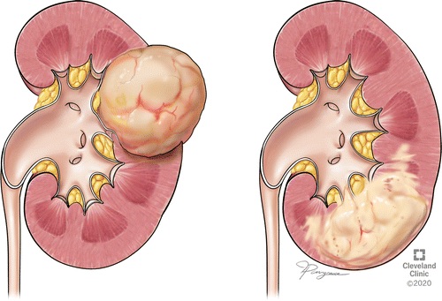 David Sweet (@davidesweet1) on Twitter photo Excited to share my first <a href="/RadioGraphics/">RadioGraphics</a> publication on infiltrative renal malignancies!
pubs.rsna.org/doi/10.1148/rg…
<a href="/ErickMRemer/">Erick Remer</a> <a href="/ClinicRadiology/">Cleveland Clinic Diagnostic Radiology Residents</a> <a href="/CleClinicUro/">Cleveland Clinic Urology</a> Excited to share my first <a href="/RadioGraphics/">RadioGraphics</a> publication on infiltrative renal malignancies!
pubs.rsna.org/doi/10.1148/rg…
<a href="/ErickMRemer/">Erick Remer</a> <a href="/ClinicRadiology/">Cleveland Clinic Diagnostic Radiology Residents</a> <a href="/CleClinicUro/">Cleveland Clinic Urology</a>