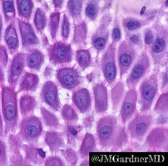 What are these cells &amp; how do you know? Answer: kikoxp.com/posts/3910/ #Pathology #dermpath #dermatology #dermatologia #dermtwitter #pathologists #pathTwitter #histology