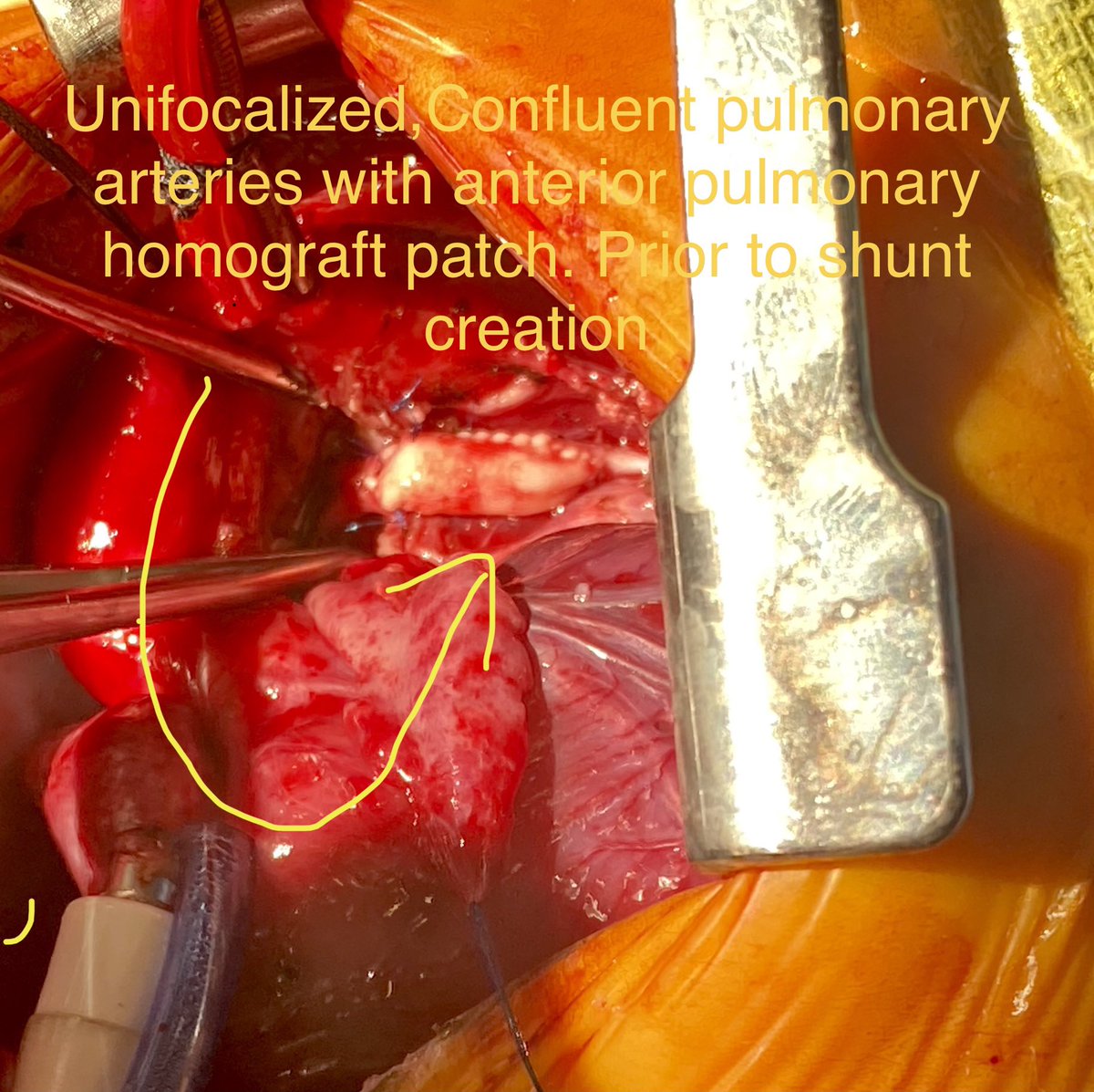 Benjamin Peeler, M.D. (@benjaminbpeeler) on Twitter photo Unifocalization(of prior tweet) <a href="/OchsnerCardio/">John Ochsner Heart & Vascular Institute</a> @OchsnerEdu <a href="/koraksarkar_M3D/">Korak Sarkar MD MHDS FAAN</a> <a href="/OchsnerHealth/">Ochsner Health</a> #medtwitter Unifocalization(of prior tweet) <a href="/OchsnerCardio/">John Ochsner Heart & Vascular Institute</a> @OchsnerEdu <a href="/koraksarkar_M3D/">Korak Sarkar MD MHDS FAAN</a> <a href="/OchsnerHealth/">Ochsner Health</a> #medtwitter