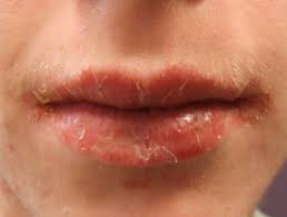 weightloss3728's tweet photo. “Professors Predicted I Would Never Cure My Angular Cheilitis. But Contrarily to their Prediction, I Cured It Easily, Permanently &amp; In a Few Hours! I'll Show You How...”
 -- Jason White  
 
C lick here for information👉👉 https://t.co/R8msximmDv
#AngularCheilitis https://t.co/XvWVhzP2hz
