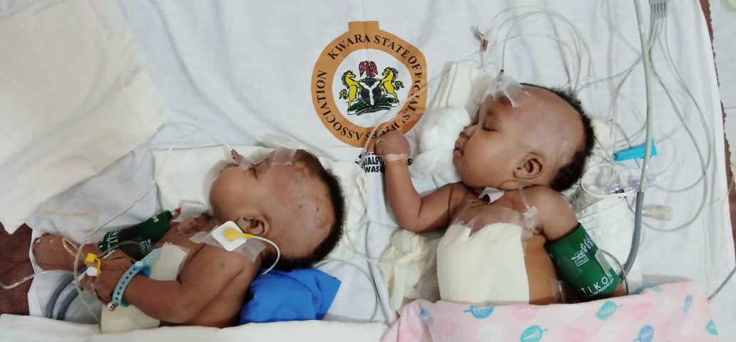 Heartwarming news of the successful separation of conjoined female twins at the University of Ilorin Teaching Hospital (UITH), yesterday. Can anyone pls confirm that these photos circulating on social media are from that surgery?