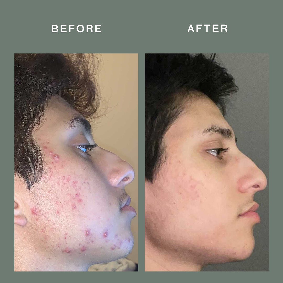Lumin acne scars discount