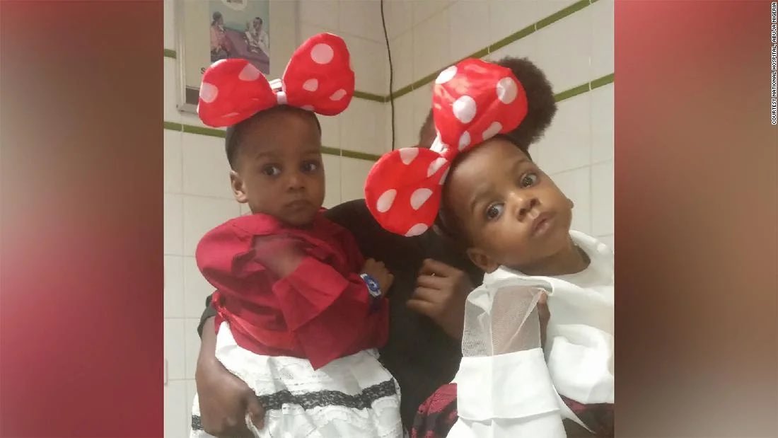 Nov 2019, another set of conjoined twins, girls, joined in the chest & stomach, were successfully separated, this time at the National Hospital Abuja. Here’s  @VOAAfrica reporting on the surgery,described as the most complicated of its kind ever in Nigeria:  https://www.voanews.com/africa/nigerias-separated-conjoined-twins-live-normal-lives