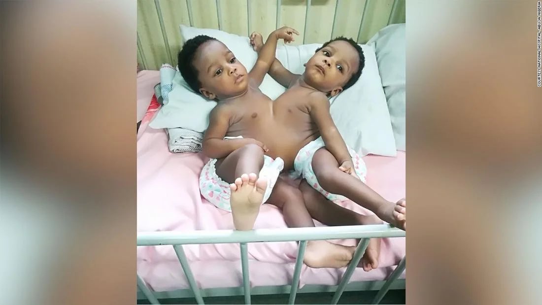 Nov 2019, another set of conjoined twins, girls, joined in the chest & stomach, were successfully separated, this time at the National Hospital Abuja. Here’s  @VOAAfrica reporting on the surgery,described as the most complicated of its kind ever in Nigeria:  https://www.voanews.com/africa/nigerias-separated-conjoined-twins-live-normal-lives