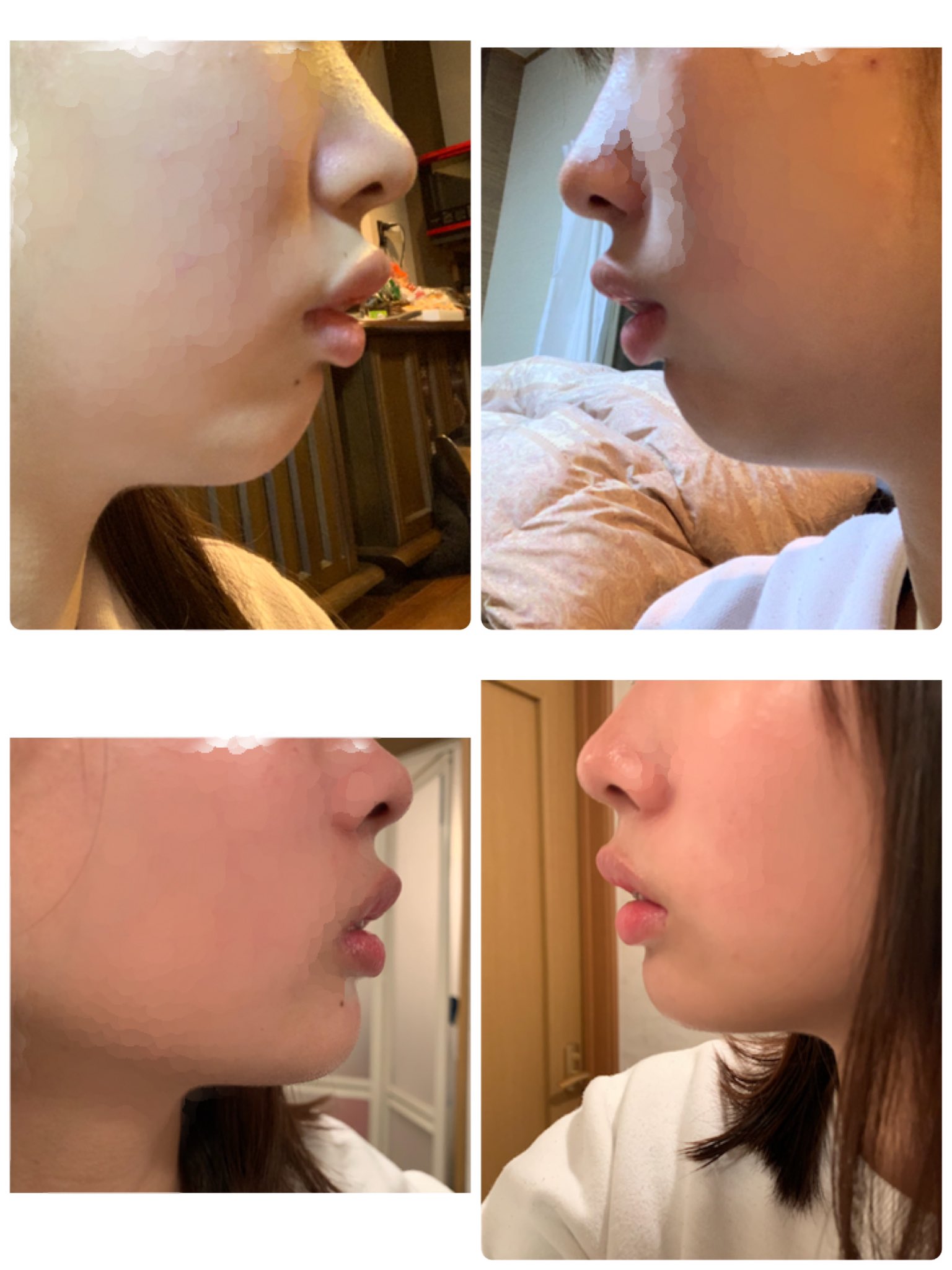 歯列矯正変化 Twitter Search Twitter