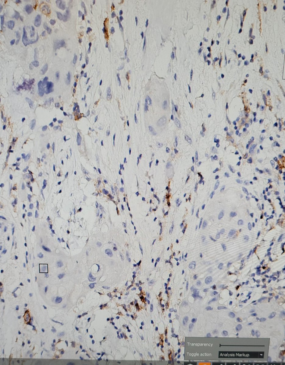 IndianPathbae's tweet photo. Quantifying IHC using digital platforms. #Digitalpathology #AIPath. https://t.co/D7RGkUYG6z